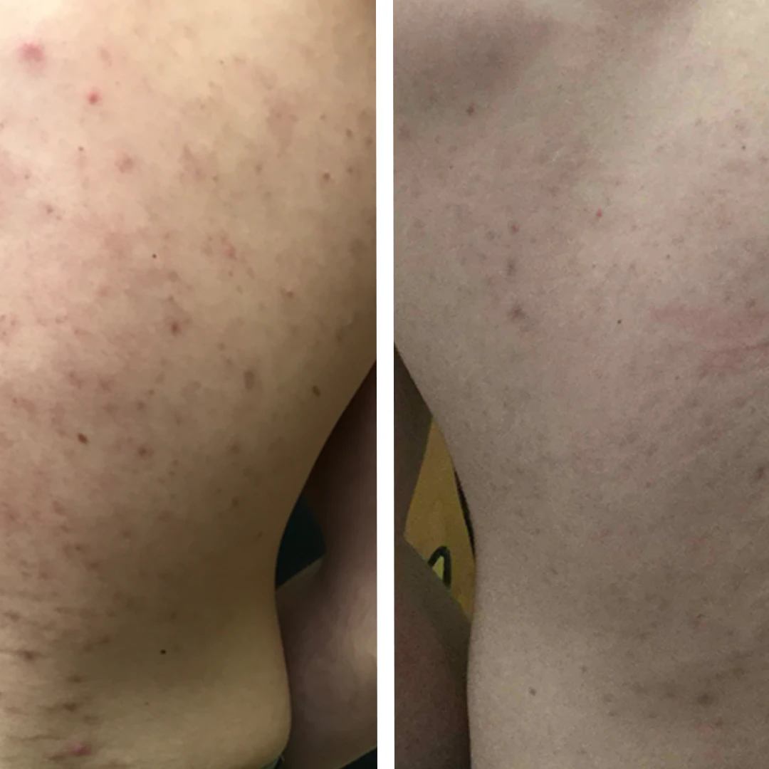 Body Acne