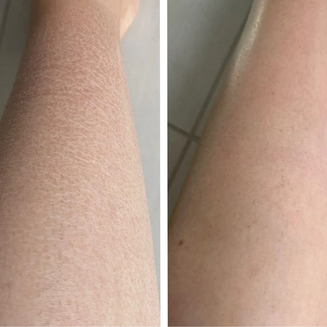 Dry & Flaky Skin