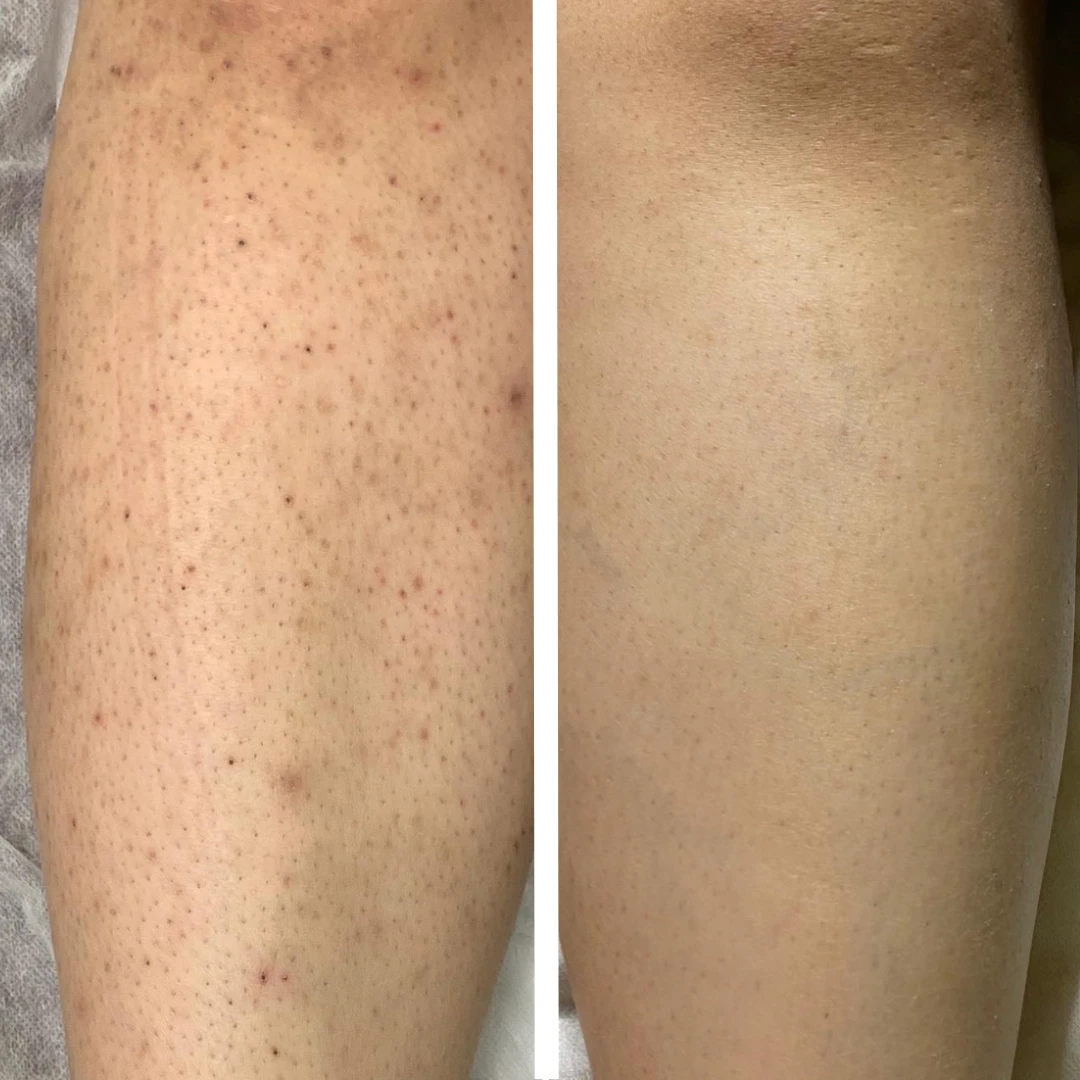 Ingrown Hairs