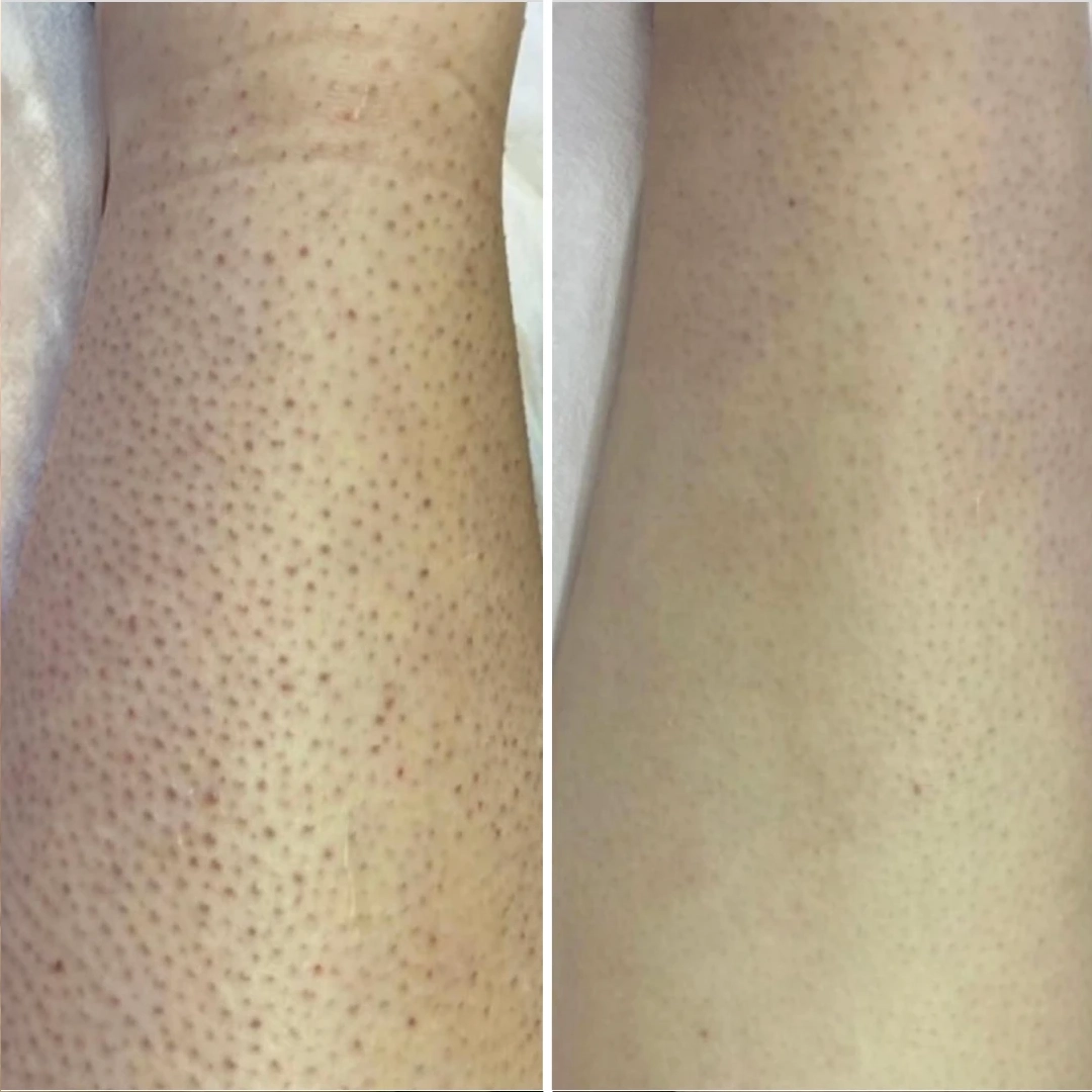 “Strawberry Skin” (Keratosis Pilaris)