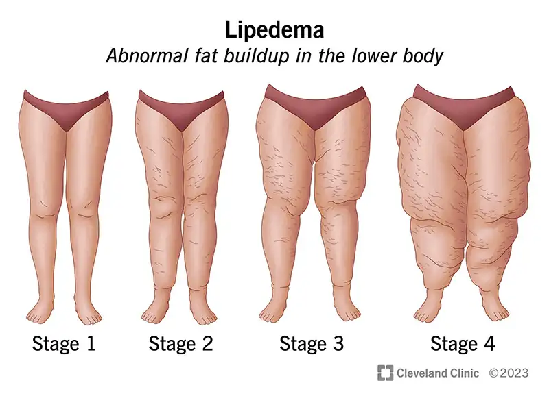 Lipedema different stages