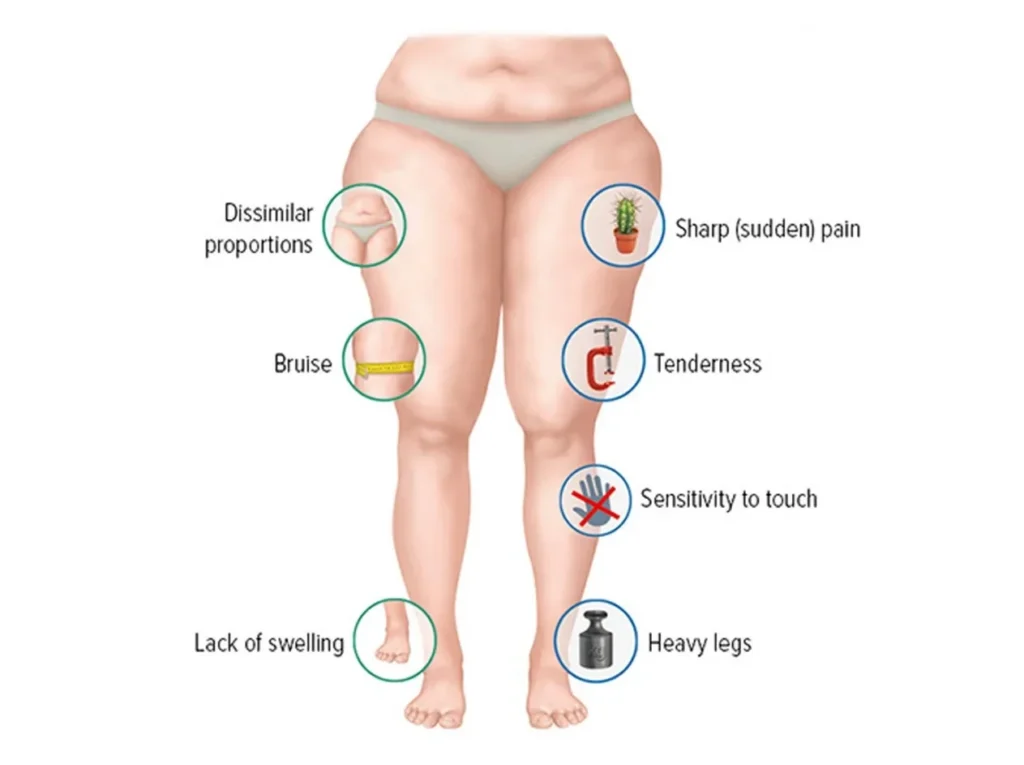 Lipedema or Just Fat Legs Learn the Real Difference