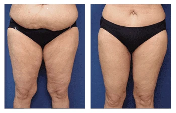 I cured my lipedema