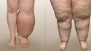 Lipedema vs Lymphedema