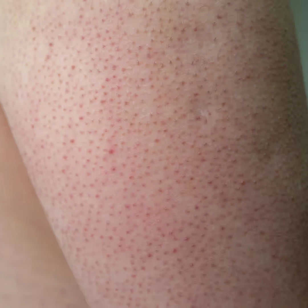 Keratosis pilaris