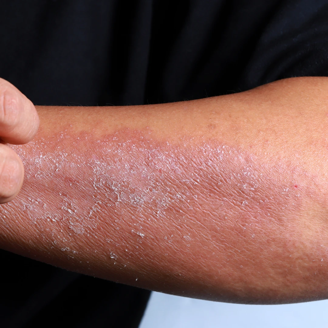 Kuiv ja ketendav nahk