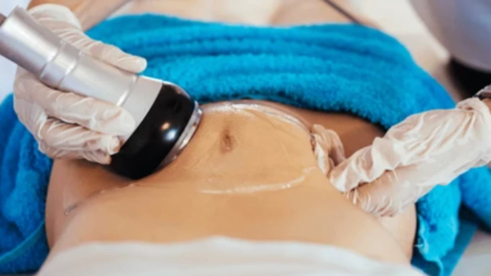 Nordenbeauty LipoSculpt Pro ultrasonic cavitation and RF device, the premium pick among top-rated cellulite massage devices