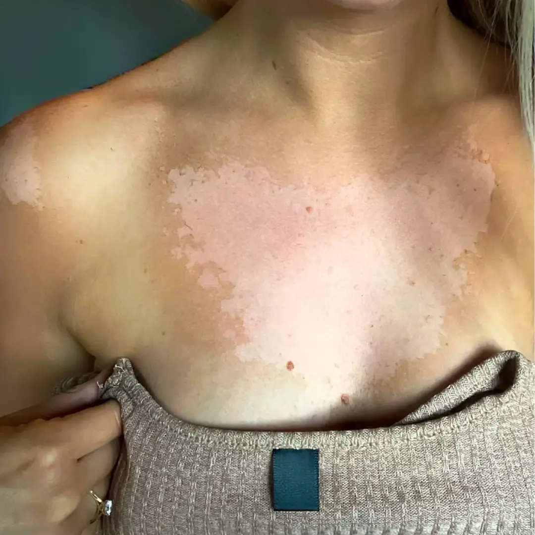 Kulunud / võltspäevitus