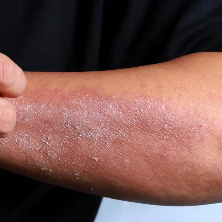 Käsivarre kuiv nahk valgete ketendustega, lähedalt fotol